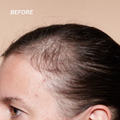 Anti-Hair Loss Serum